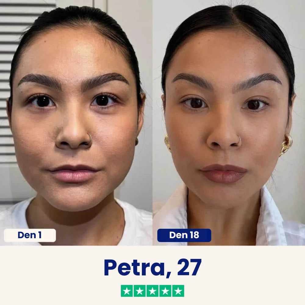 Yuma Beauty™ Lift: Verabschieden Sie sich noch heute von Ihrem Doppelkinn