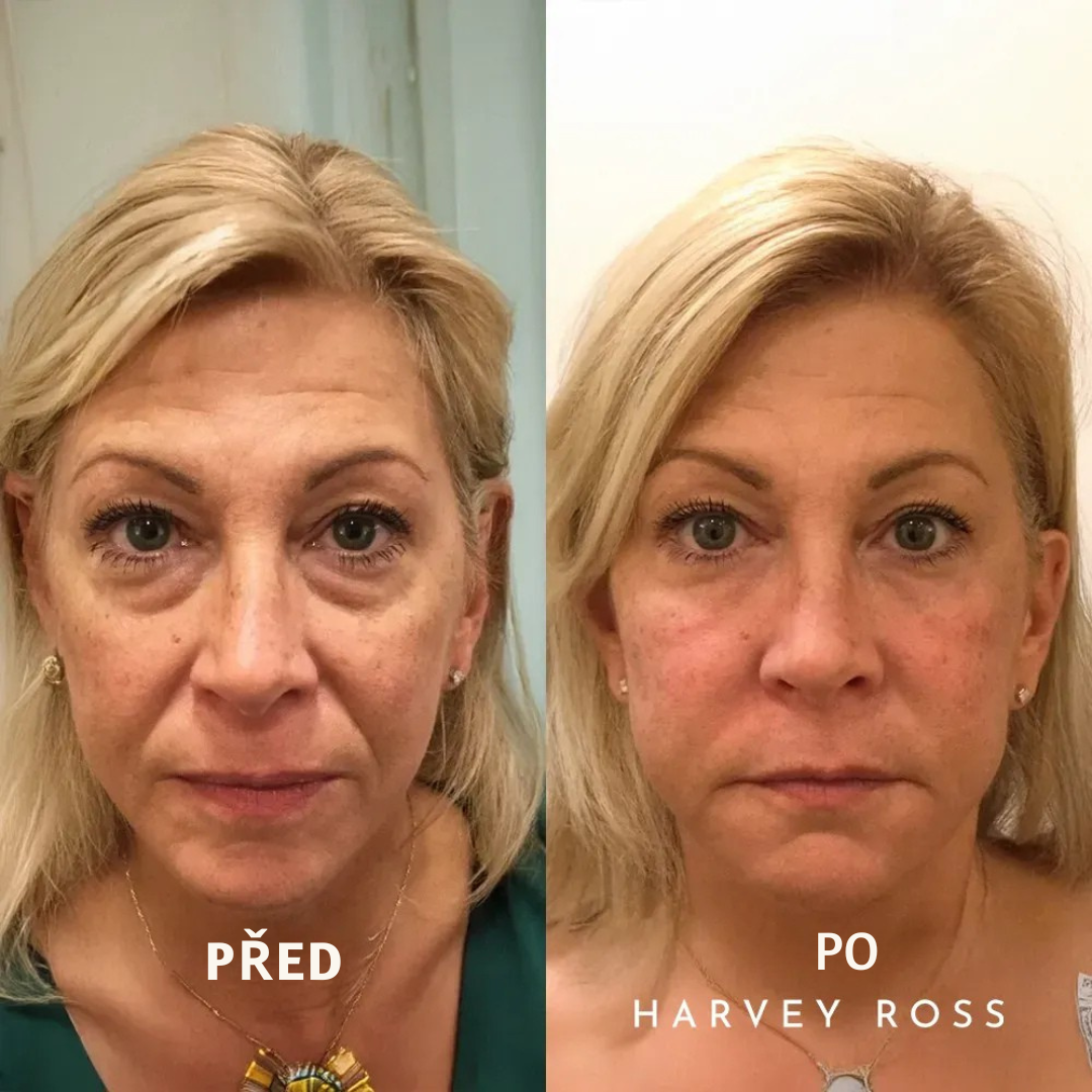 Yuma Beauty - Harvey Ross Kamžitý Lifting