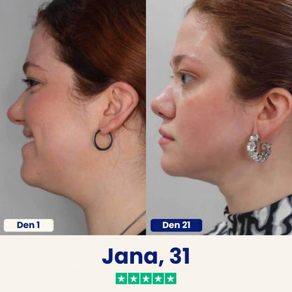 Yuma Beauty™ Lift: Verabschieden Sie sich noch heute von Ihrem Doppelkinn.